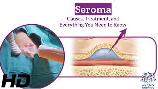 Seroma Breakdown: Causes, Treatment Options, and Essential Tips