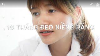 [Niềng răng] SỰ THAY ĐỔI SAU 10 THÁNG - Gemie Ploy