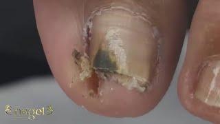  OLHA O BURACO QUE FICOU ALI DEPOIS QUE EU DESENCRAVEI AQUELA PARTE ESCURA #satisfying #nails