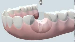 Cómo se coloca un implante dental