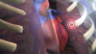 How a Clot Can Become a Pulmonary Embolism