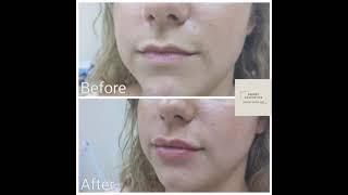 Natural lip filler enhancement @ Skinox Aesthetics