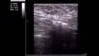 La Scleroterapia Ecoguidata - vene varicose, veneinforma
