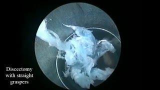 Right Transforaminal Endoscopic Discectomy