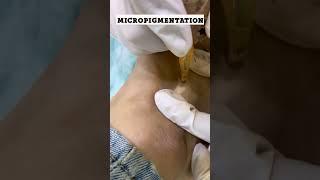 Best Treatment of Vitiligo or White Patches with Vitiligo Surgery at Skinaa #viral #shorts