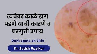 त्वचेवरील काळे डाग जाण्यासाठी घरगुती उपाय : डॉ सतीश उपळकर | Dark spots on Skin home remedies