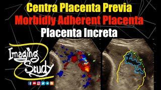 Placenta Previa | Placenta Increta | Morbidly Adherent Placenta || Ultrasound || Doppler || Case 283