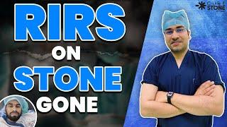 RIRS ON STONE GONE | New Technique - Laser Kidney Stone Treatment | RIRS - Dr. Deepanshu Gupta