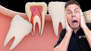 Is Removing Your Wisdom Teeth BAD For You?!