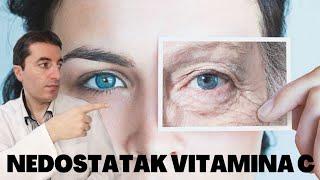 Prvi jasni simptomi NEDOSTATKA VITAMINA C