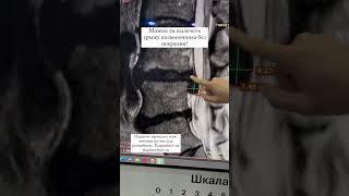 Грыжа позвоночника. Лечение без операции. #позвоночник