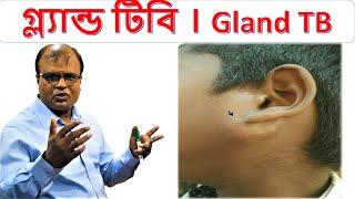 গ্ল্যান্ড টিবি । Gland TB । Homoeopathic treatment । Dr Md Abdul Mannan