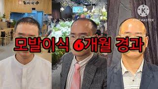 [kj walker 새로운길 : 모발이식 vlog2]모발이식후 6개월 경과한 모습을 공개합니다 ^-^