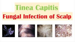 Fungal Infection of the Scalp (Tinea Capitis) | Causes, Risk Factors, Symptoms, Diagnosis, Treatment