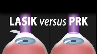 LASIK or PRK? Which is right for me? Animation.