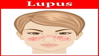 Lupus Rash: Plaquenil & Cellcept Didn't Help Her