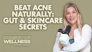 How I Healed My Acne: Gut Health, Treating H. Pylori & Skincare