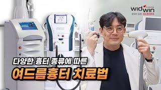 흉터 종류에 따른 다양한 여드름흉터 치료법!