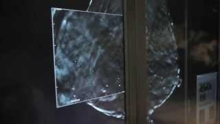 Hologic 3D mammography video