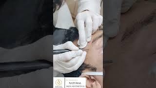 Freckles Removal Treatment | Dr.Ashwinis permanent Cosmetic |naturalbrowsacadmy