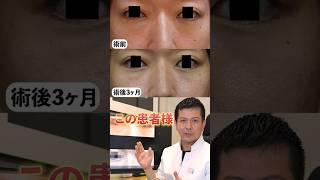 水の森美容クリニックのクマ治療 再発の真実とは... #shorts