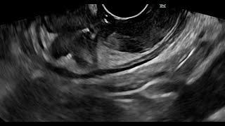 FLORIDA LIVE EUS (AUG 21-23, 2025) TEACHING VIDEO. WORDS OF WISDOM FROM EUS TO RESECTION ENTHUSIASTS