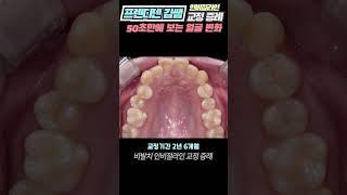 50초만에 변하는 교정 마술, 덧니, 치아교정 전후, 토끼이빨교정, 비발치교정 (인비절라인 치아교정 기간 2년 6개월 후기)