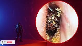 The Truth About earwax Will Shock You. How to remove earwax from ear, earwax extractions