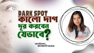 Dark Spot/কালো দাগ দূর করবেন যেভাবে