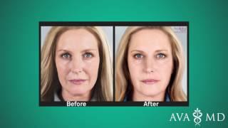 Are Sculptra Injections Right for You?