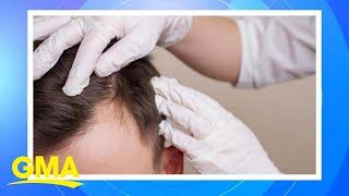 New study finds some natural hair loss remedies may work | GMA