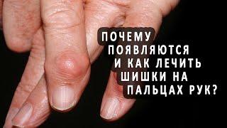 Почему появляются и как лечить шишки на пальцах рук?