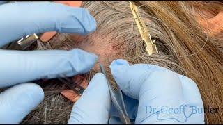Removal of two Pilar cysts