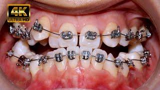 Braces transfomation 4k