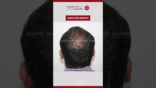 See our #malehairlosstreatment Patient Success Stories.  #hairlossresults #hairlosstreatmentresults