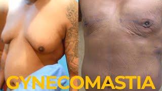 Gynecomastia Surgery: ONLY 48 HOURS POSTOPERATIVE‼️RESULTS️