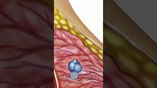 Breast Biopsy Wire Localization: Step-by-Step Guide   PreOp® #PreOp #Shorts #BreastBiopsy