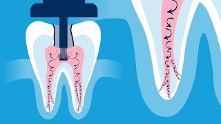 Discover the Innovative GentleWave® Procedure