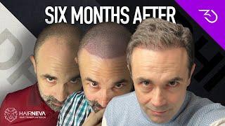 Best Hair Transplant In Turkey - DHI 6 months results