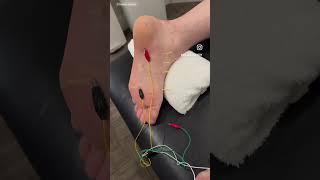 Dry Needling for #plantarfasciitis ; #plantarfasciitisrelief #footpain #dryneedling #acupuncture