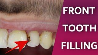 Front Teeth Filling Process | Dentist do front tooth decay repair | Composite bonding restoration