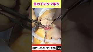 【閲覧注意】目の下のクマ取り！グロいです。