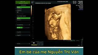 EM BÉ CỦA MẸ NGUYỄN THỊ VÂN - SƠN ĐÔNG LẬP THẠCH VĨNH PHÚC - THAI 12 TUẦN