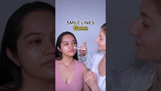 smile lines disappeared #smilelines #facemassage #faceyoga #faceexercises #facefitness