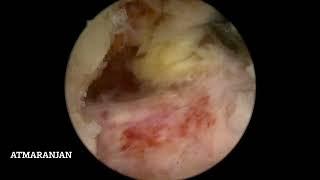 Revision lumbar canal stenosis   by endoscopic biportal spine endoscopy/ube. Dr Atmaranjan Dash