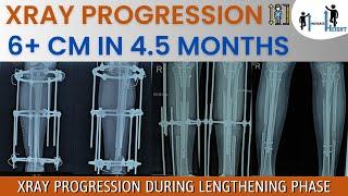 XRay Progression during Lengthening Phase, Increase 6cm Height with Limb Lengthening Surgery Gurgaon