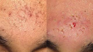 ASMR BLACK SPOTS ACNE CLEANING / SKIN CARE ( NO ADVERTISING)