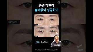 중년 하안검 수술! 흉터가 제일 고민이시죠? #shorts