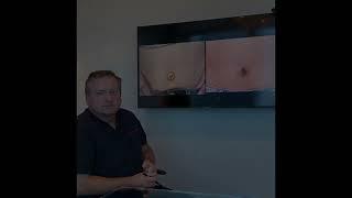 Dr. Svehlak: Getting A Bikini-Ready Belly Button For Summer