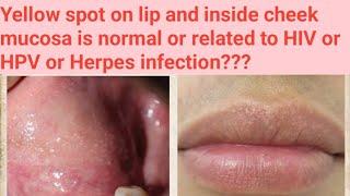 yellow spot on lip,what to do?Fordyces granules in cheek related to HIV or HPV or Herpes infection?